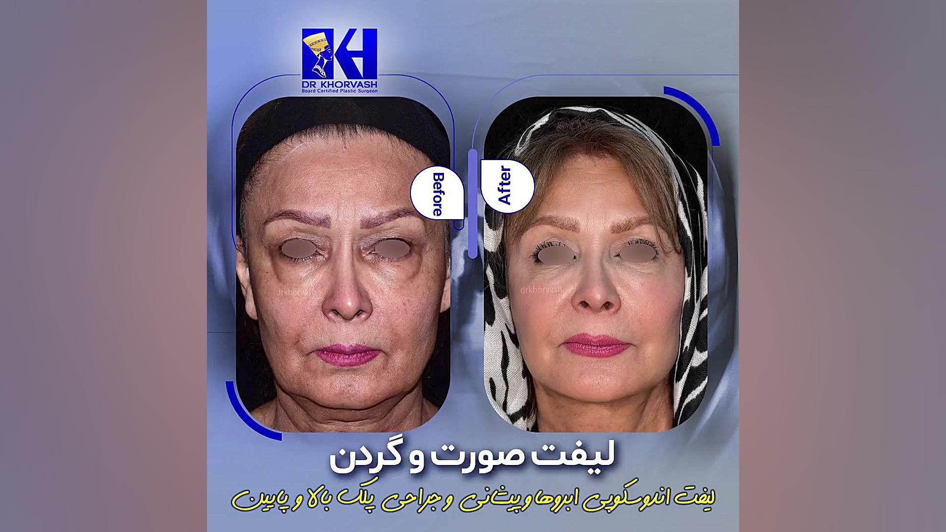 لیفت صورت و گردن و لیفت آندوسکوپی پیشانی و ابروها و جراحی 4 پلک ترمیم لبخند لثه‌ای