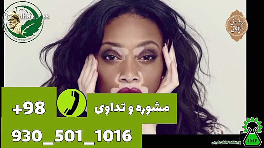 تداوی ویتیلیگو پیسی برص vitiligo مارال فرجاد
