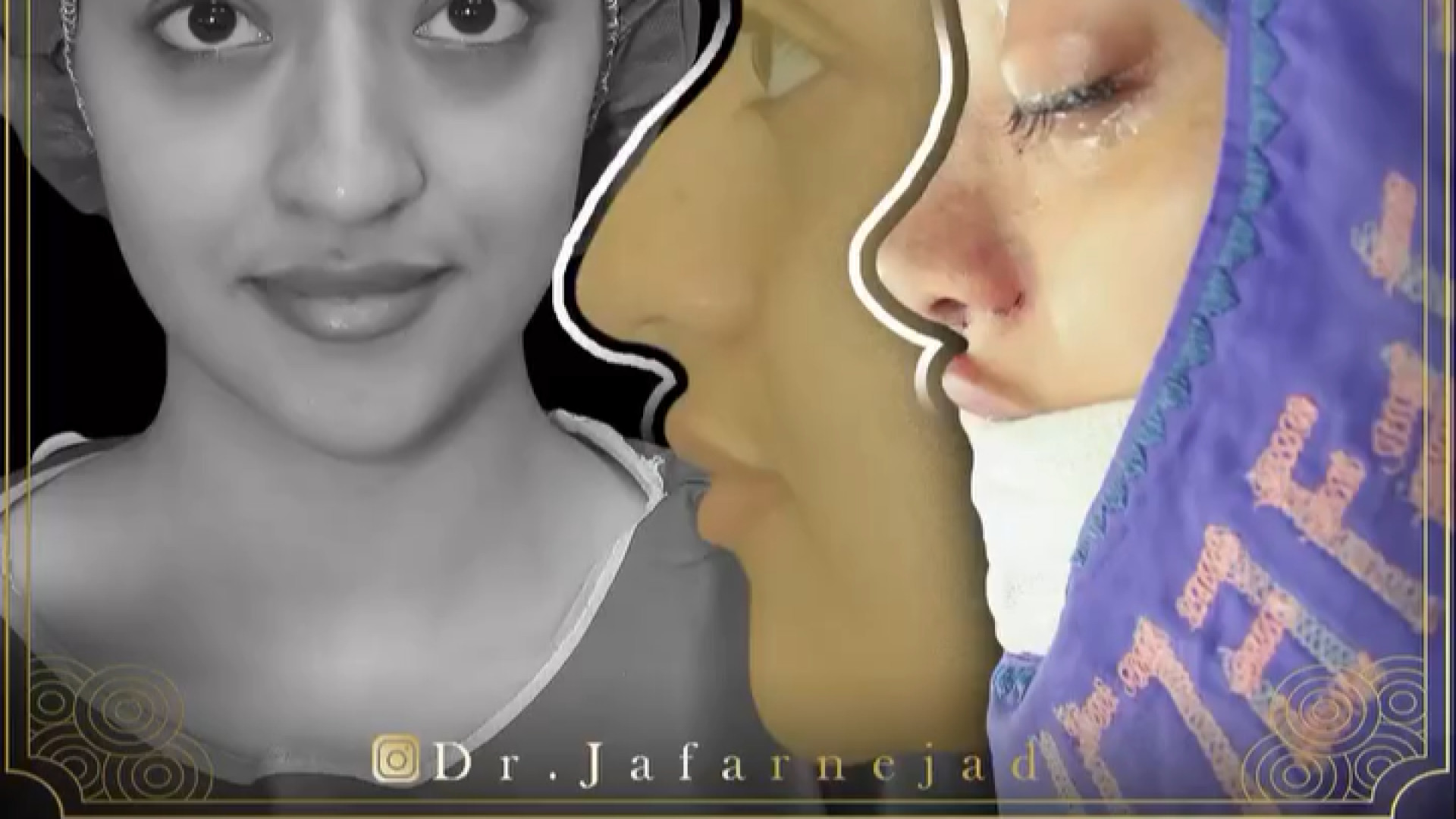 عمل بینی ترمیمی نیمه فانتزی دکتر بابک جعفرنژاد