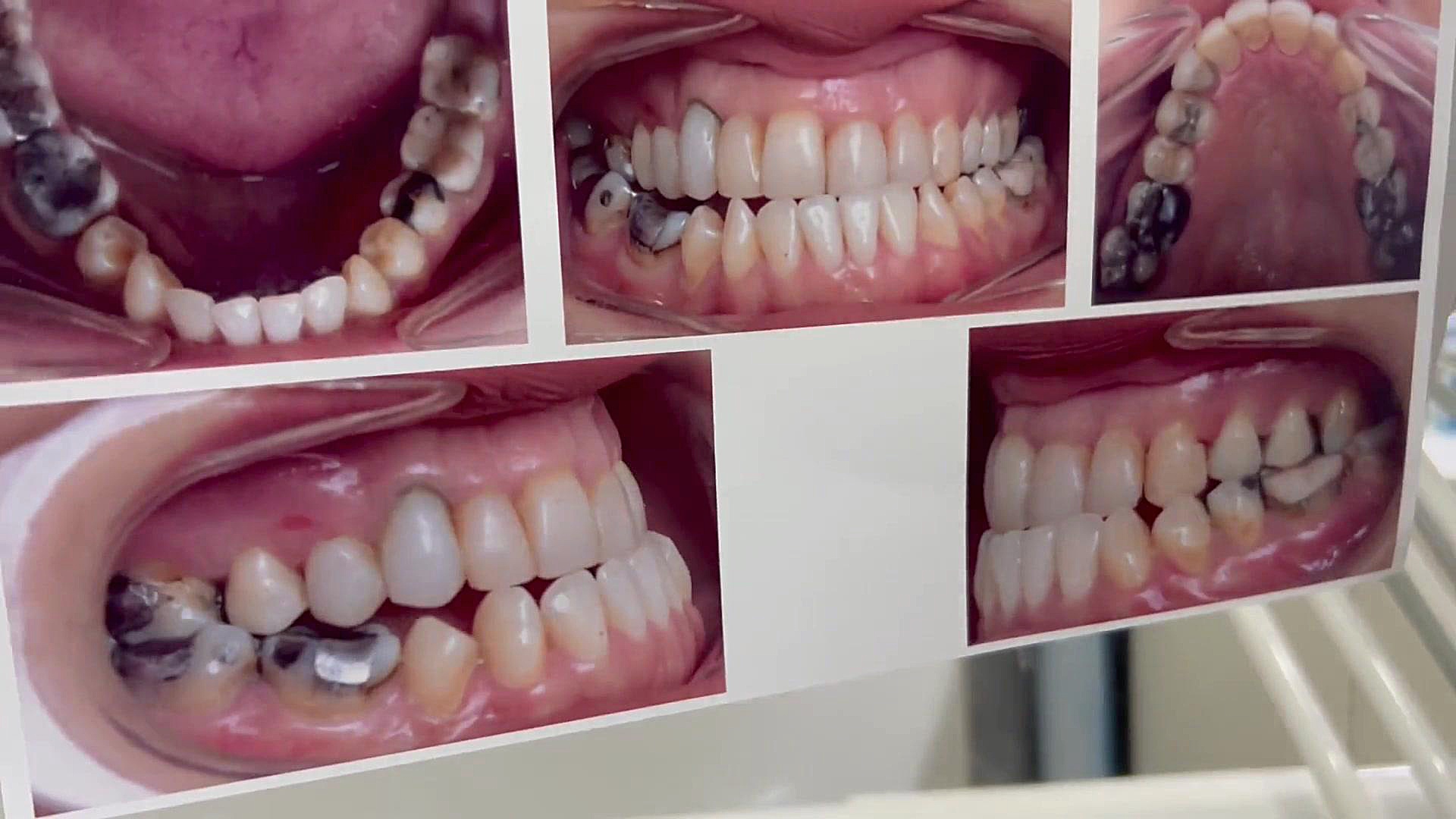 ارتودنسی برای جراحی فک پایین دكتر مهدي فهيمي هنزائي