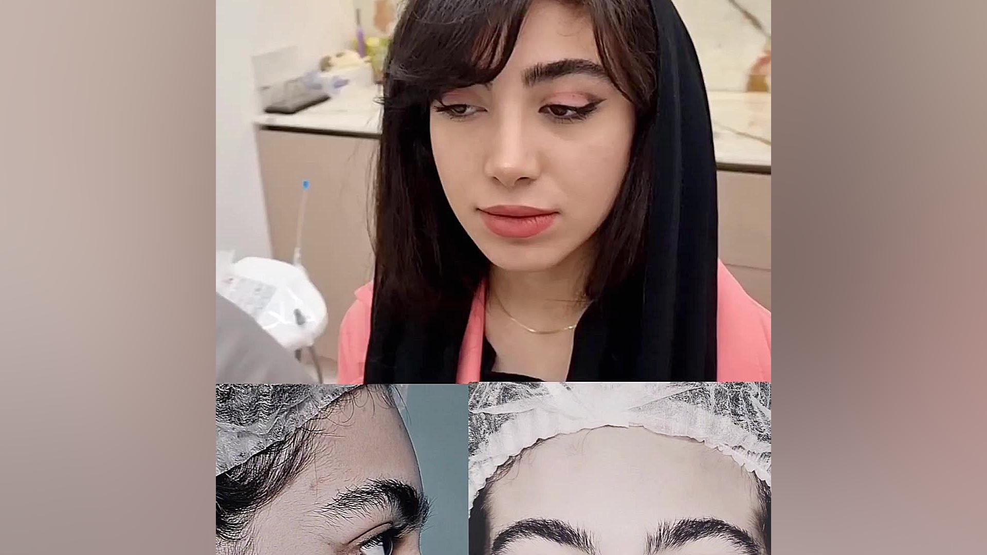 نتیجه دو ماه بعد از جراحی زیبایی بینی دکتر علی شفیعی رونیزی | بهترین جراح بینی تهران