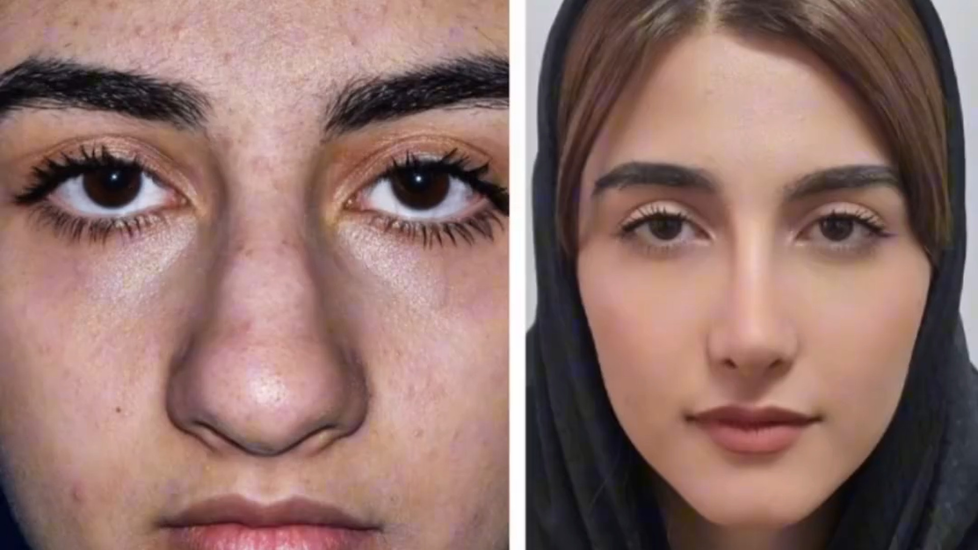 نمونه کارهای عمل بینی توسط دکتر علی شفیعی دکتر علی شفیعی رونیزی | بهترین جراح بینی تهران