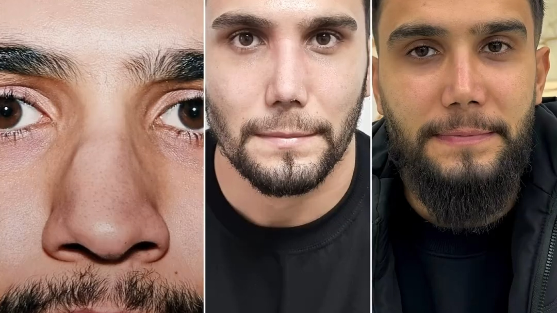تغییرات بینی بعد از جراحی دکتر علی شفیعی رونیزی | بهترین جراح بینی تهران