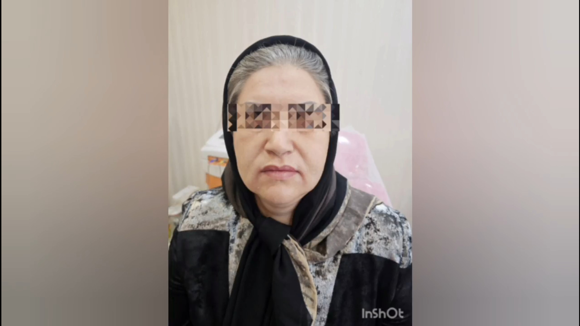 نتیجه لیفت صورت با نخ (2) ترمیم زیبایی دندان
