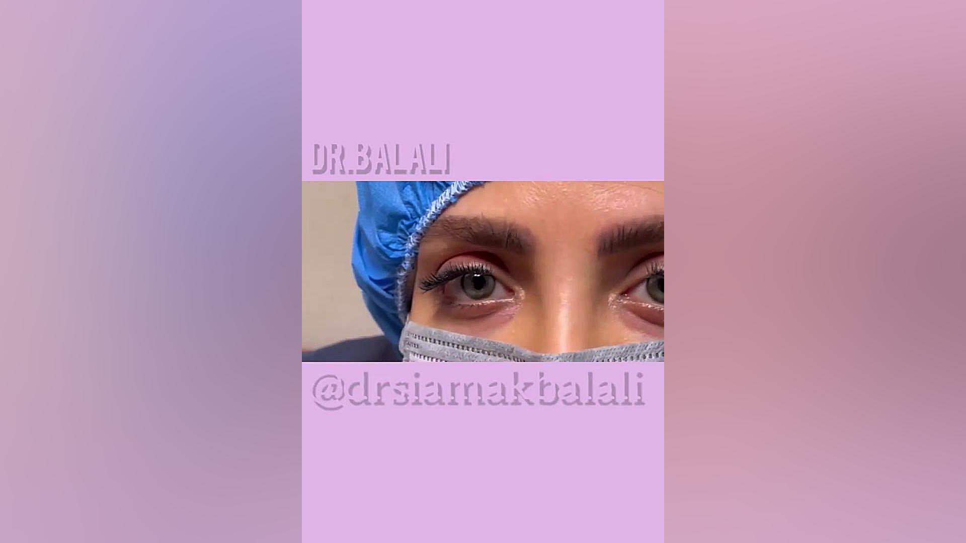 تغییر رنگ چشم توسط دکتر سیامک بلالی دکتر سیامک بلالی