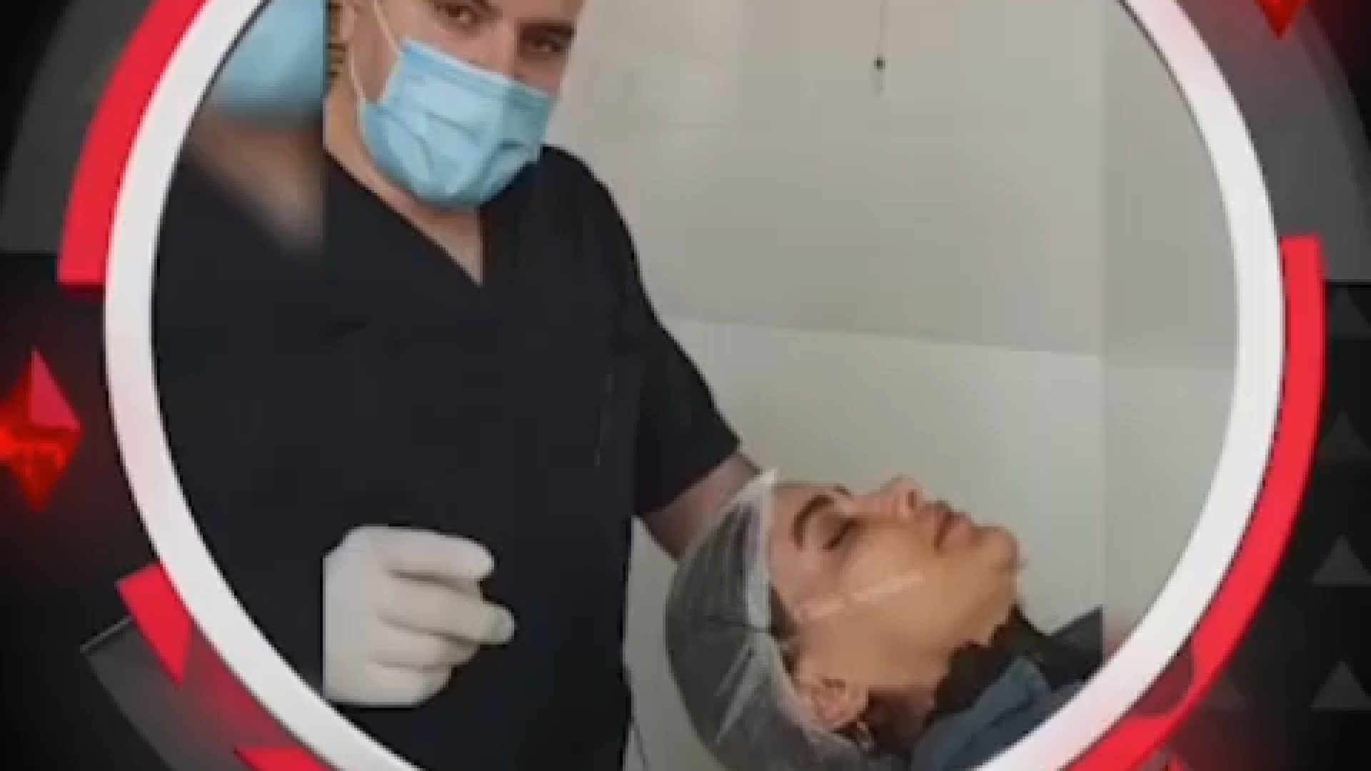 لیفت صورت با نخ اصلاح طرح لبخند