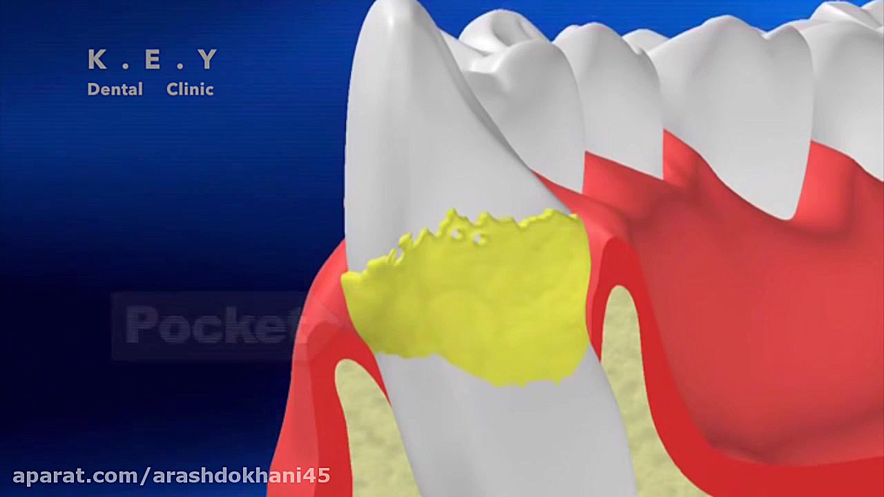 بیماری های لثه و جرم گیری دکتر آرش دخانی