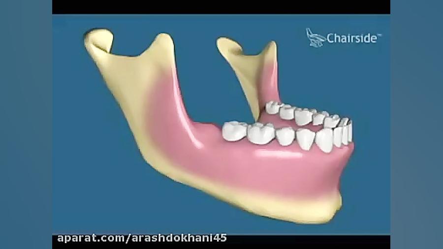 جراحی دندان عقل نهفته دکتر آرش دخانی