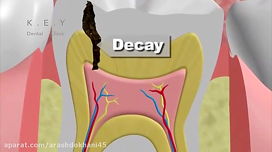 درمان ریشه با روتاری دکتر آرش دخانی