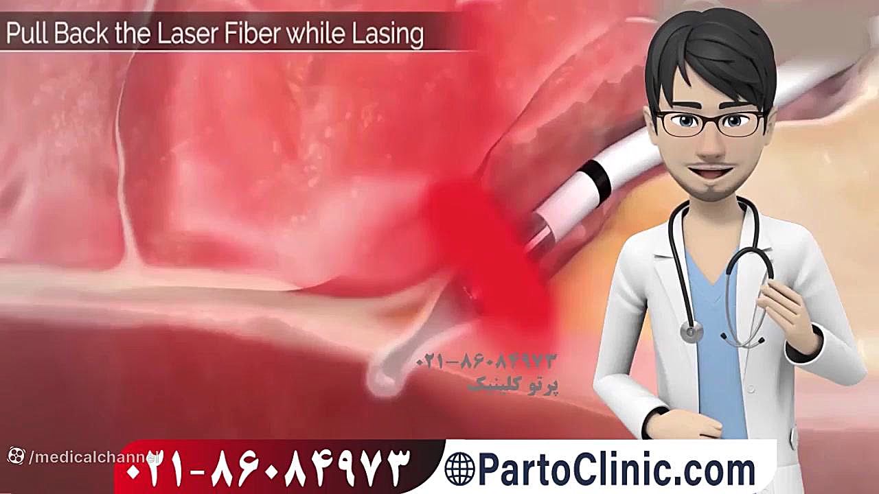 فیلم عمل فیستول با لیزر- پرتو کلینیک کاتاپلکسی