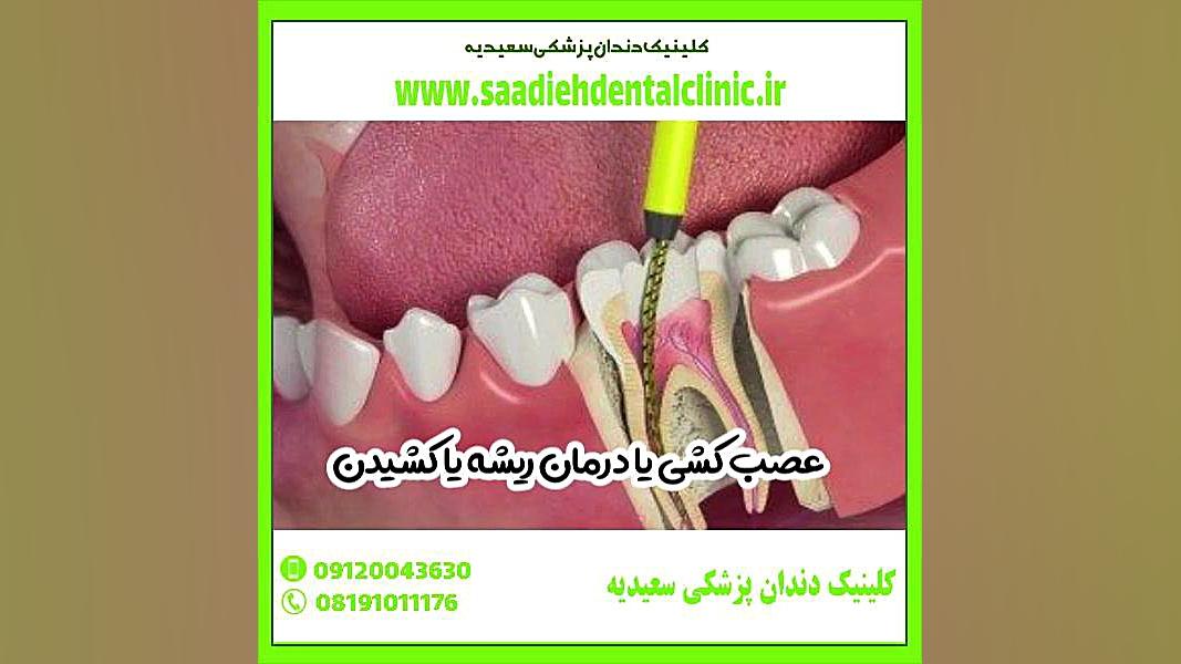 پر کردن دندان بهتر است یا عصب کشی ترمیم سوختگی