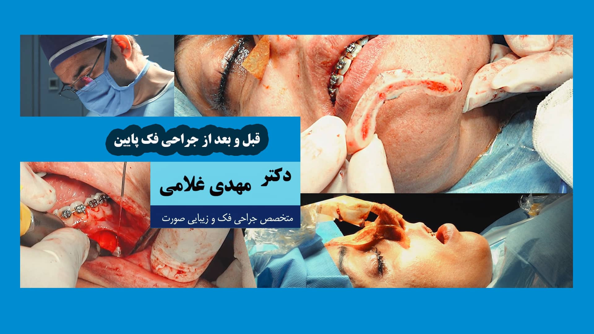 قبل و بعد از جراحی فک پایین توسط دکتر مهدی غلامی در مشهد دکتر مهدی غلامی