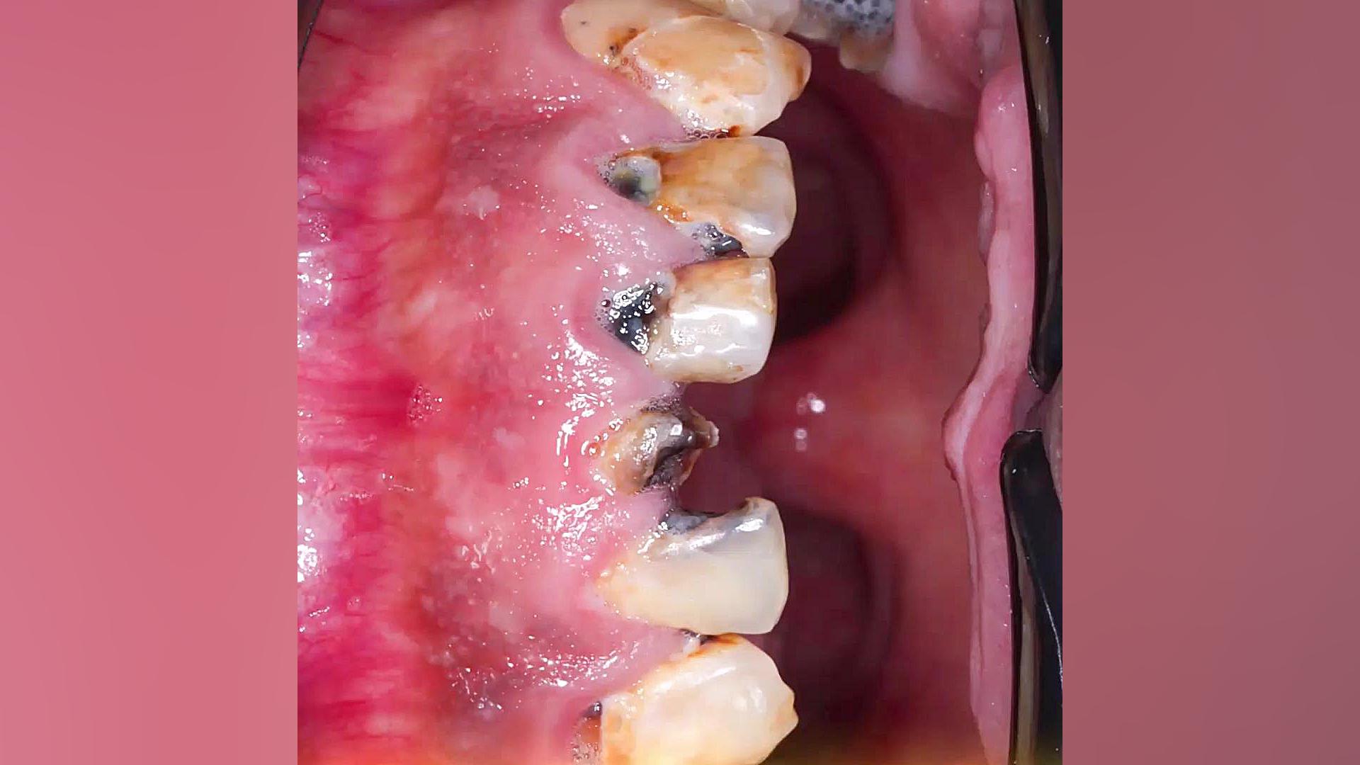 طراحی لبخند و بازسازی کامل دهان با ایمپلنت و روکش های تمام سرامیک دکتر عباس گشاده رو، متخصص جراحی لثه و ایمپلنت