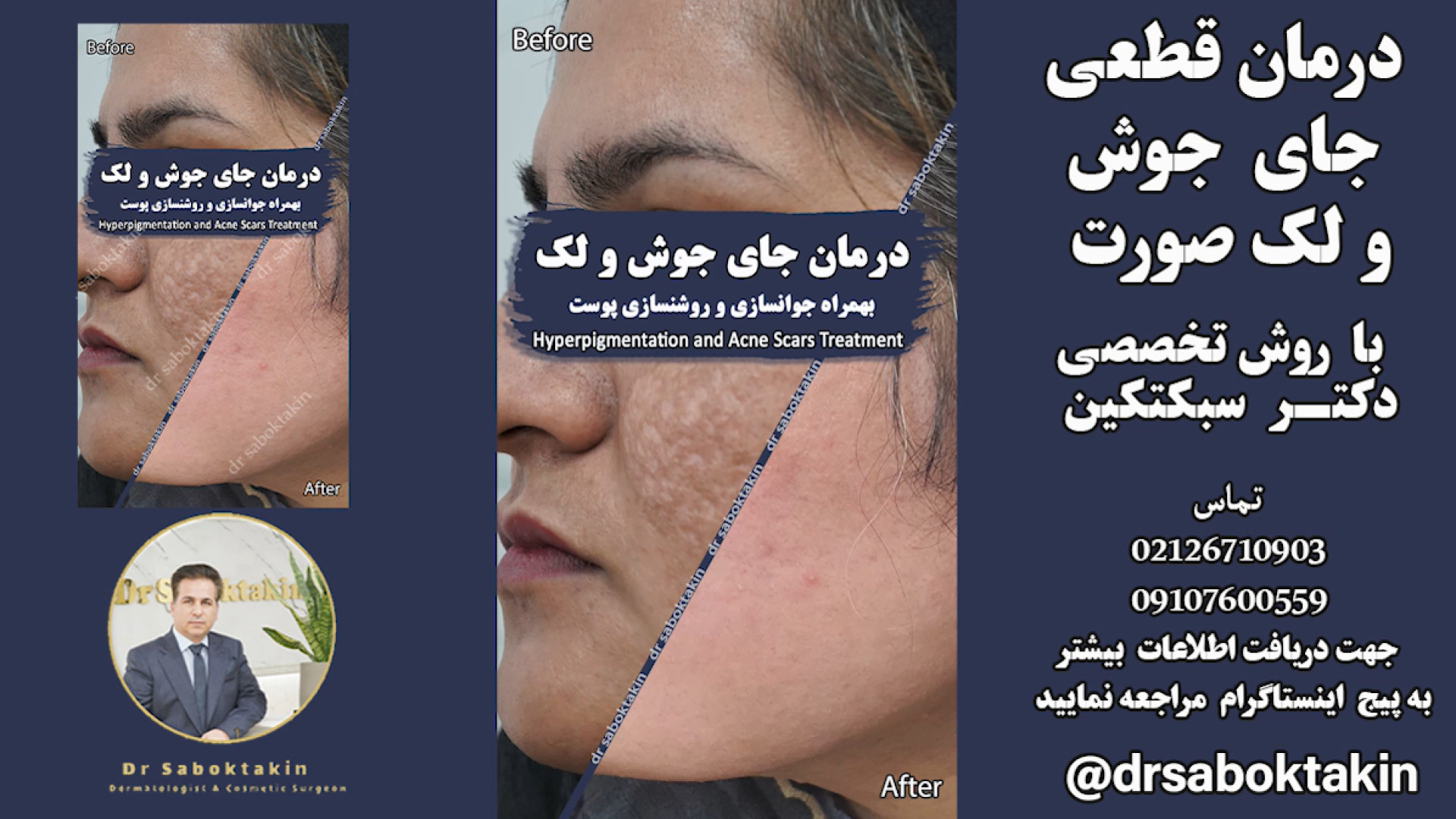 درمان قطعی لک عمیق و لیزر جای جوش صورت 1 acne scars hyperpigmentation treatment لیپوساکشن