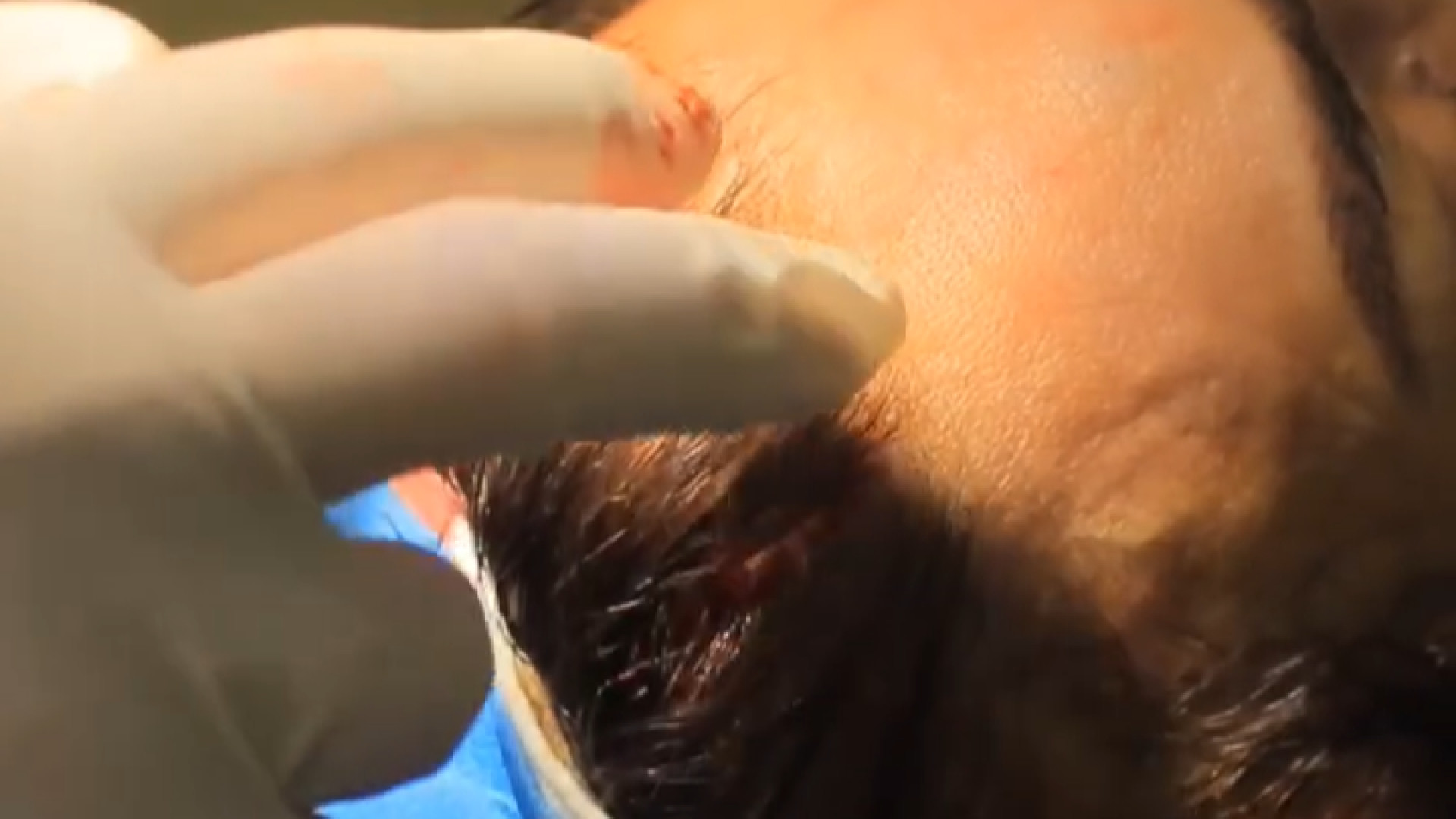 فیلم واقعی لیفت صورت(قسمت اول) دکتر محمدرضا آخوندی نسب-فوق تخصص جراحی پلاستیک