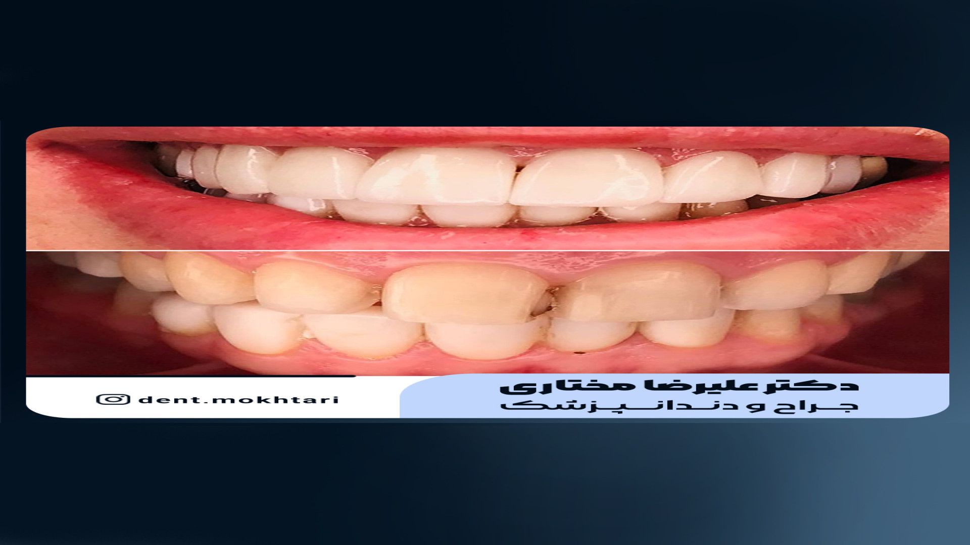 کامپوزیت فیسینگ دکتر علیرضا مختاری Northern Blot