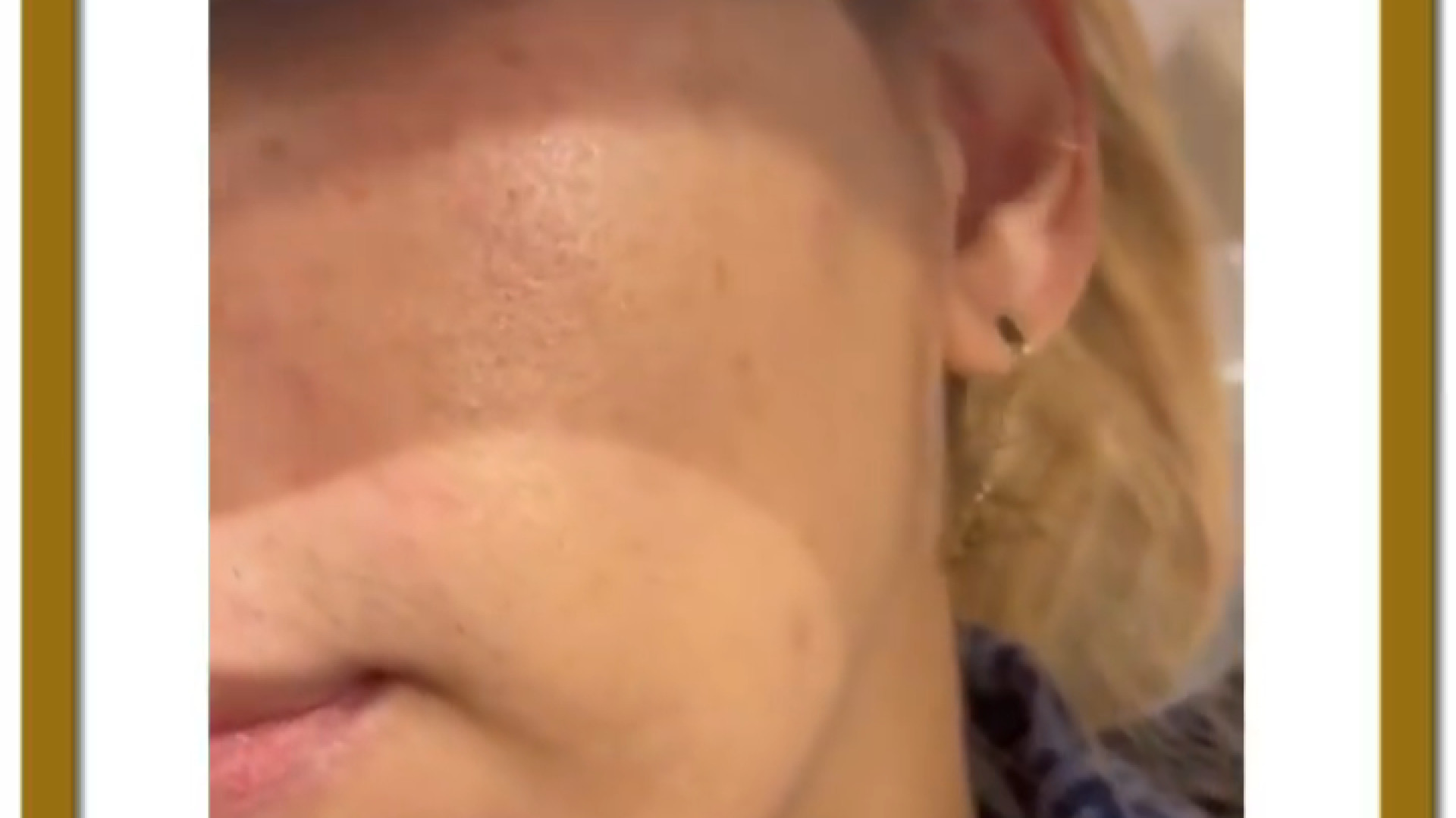 درمان لک صورت با پروسترولین لیفت صورت