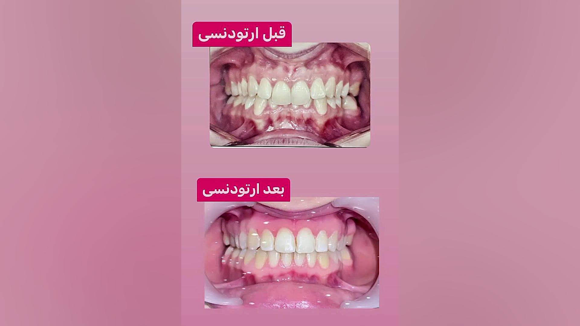 قبل و بعد ارتودنسی دکتر فهیمی دكتر مهدي فهيمي هنزائي