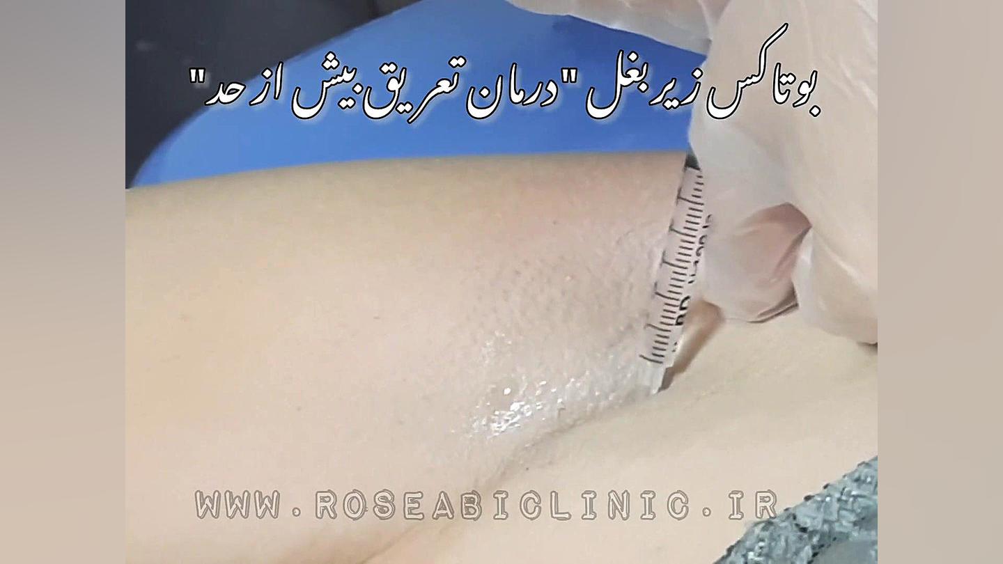 بوتاکس زیربغل درمان تعریق کربوکسی تراپی