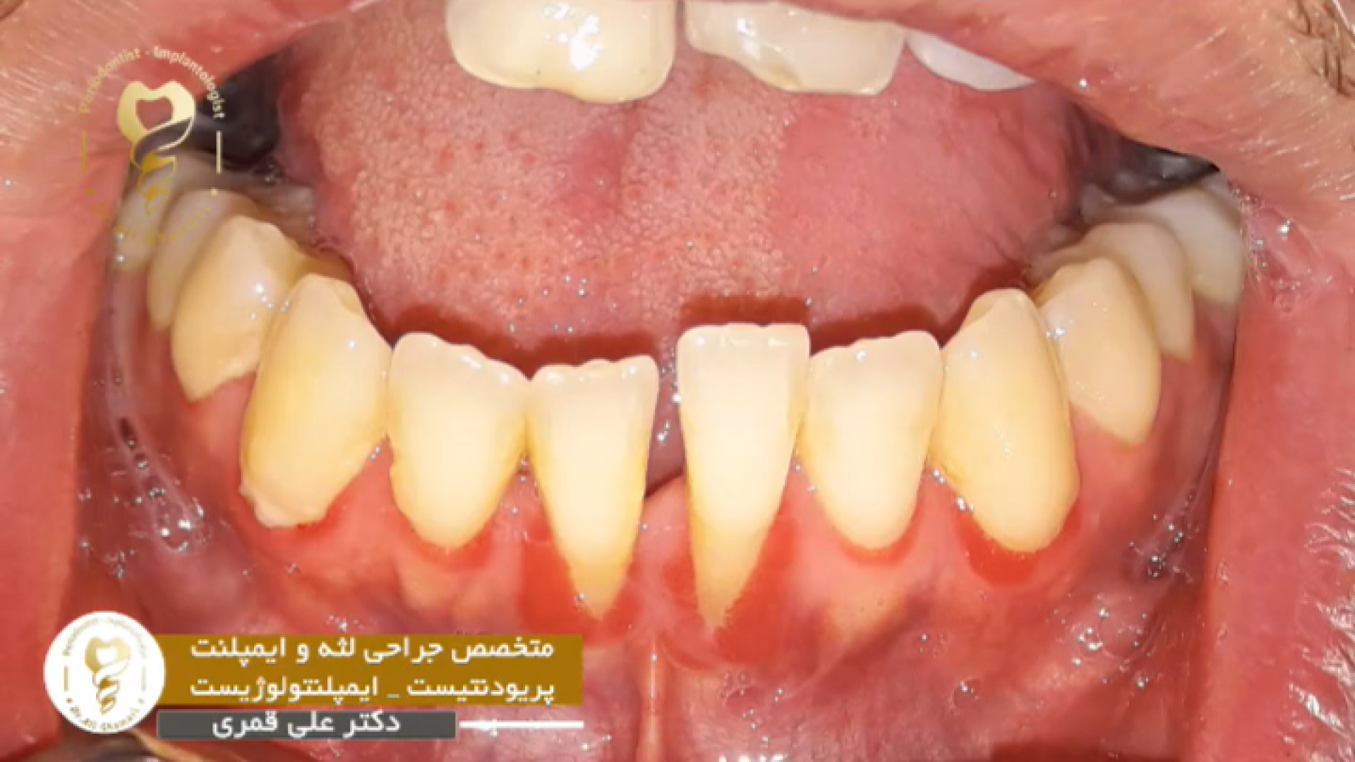 جراحی پیوند لثه فک پایین بیماری نوری آسیب ارثی