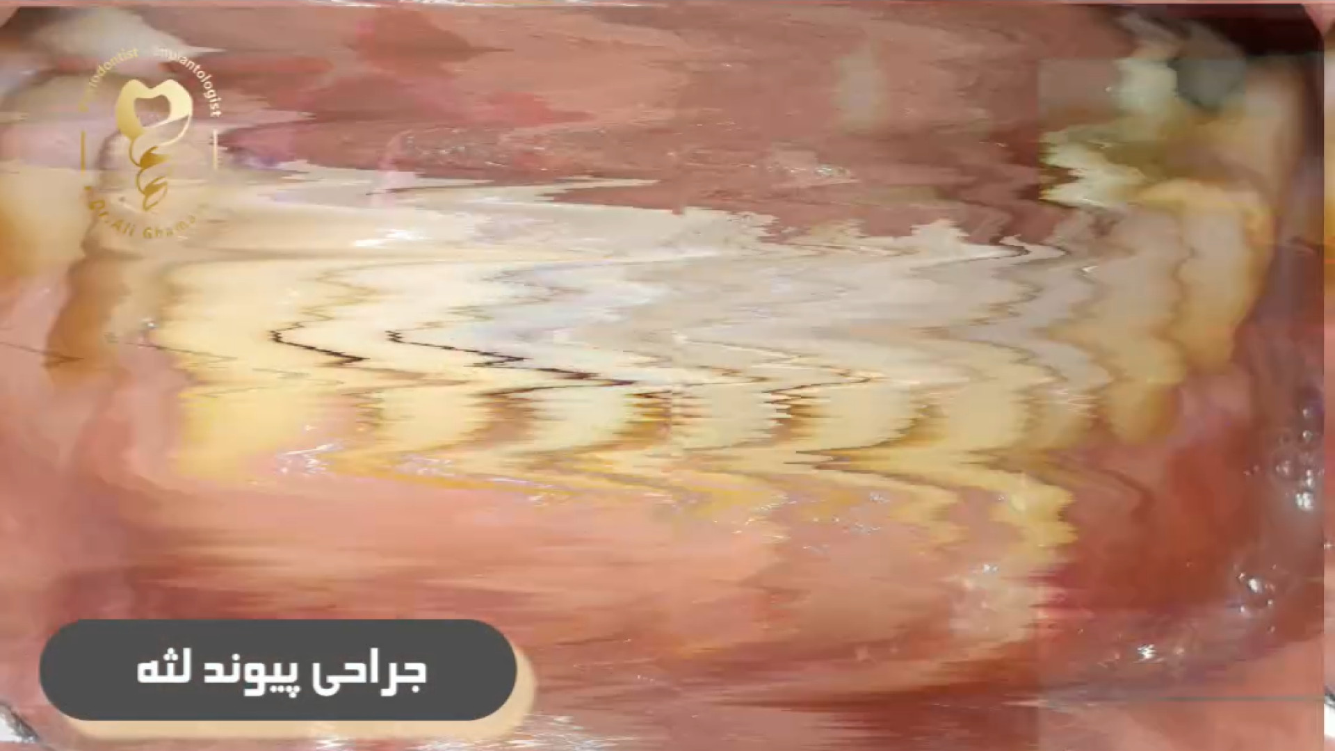 فیلم پیوند لثه فک پایین دکتر علی قمری - متخصص جراحی لثه و ایمپلنت