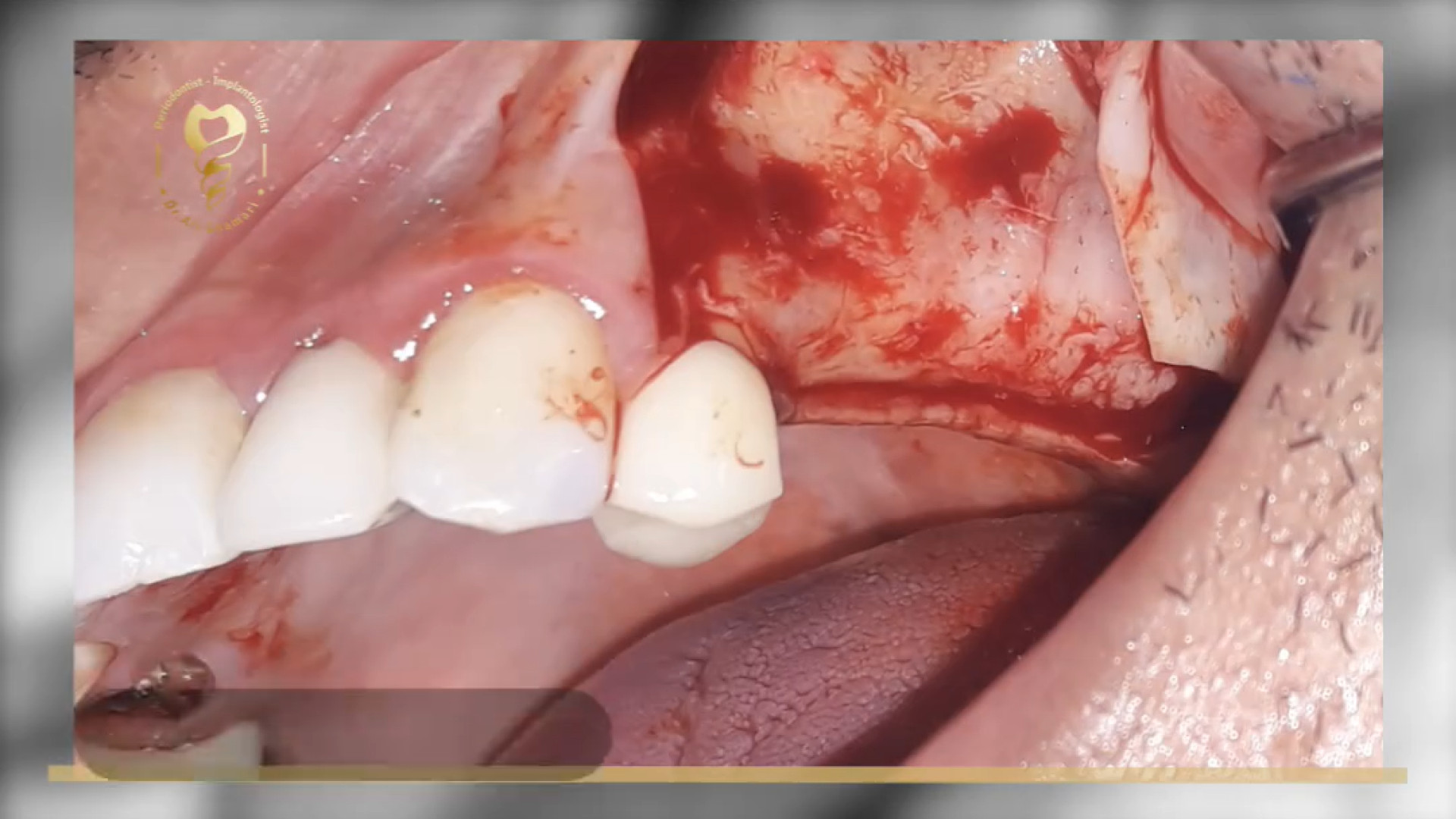 جراحی ایمپلنت دندان به همراه سینوس لیفت دکتر علی قمری - متخصص جراحی لثه و ایمپلنت