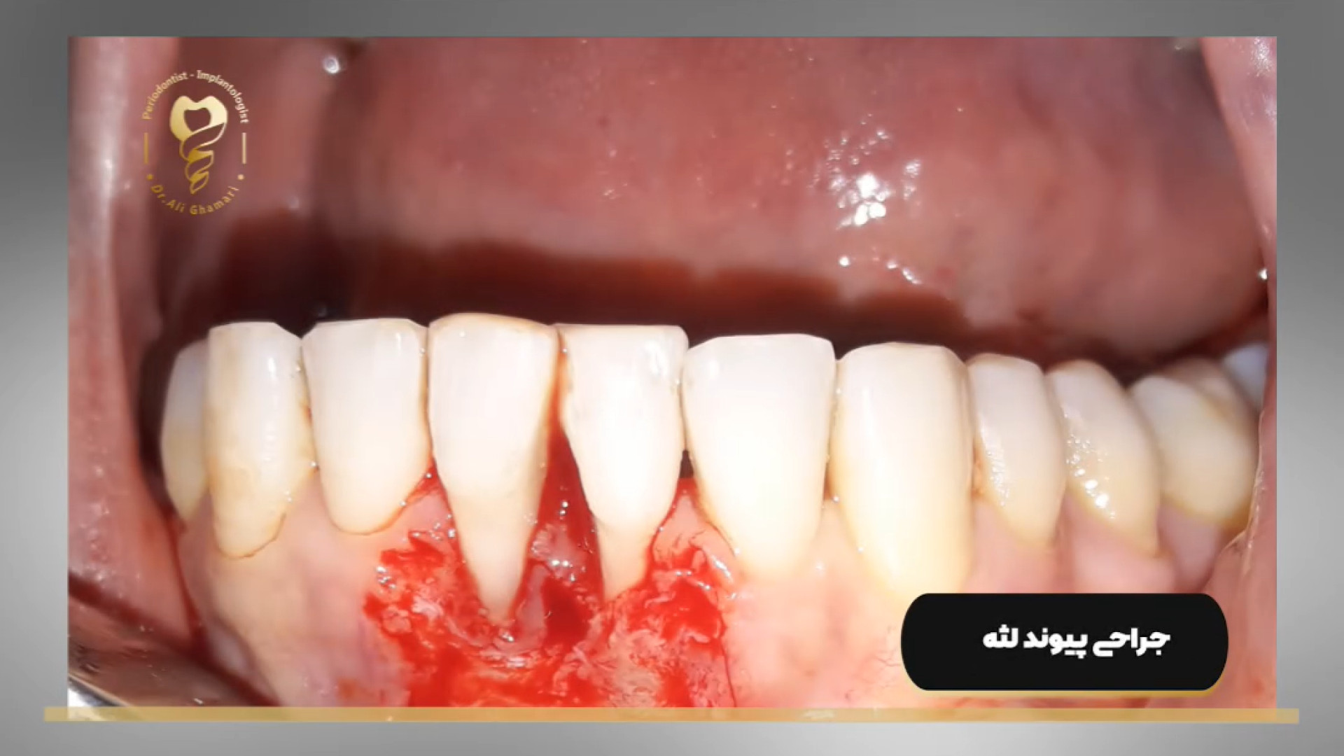 فیلم عمل پیوند لثه دکتر علی قمری - متخصص جراحی لثه و ایمپلنت