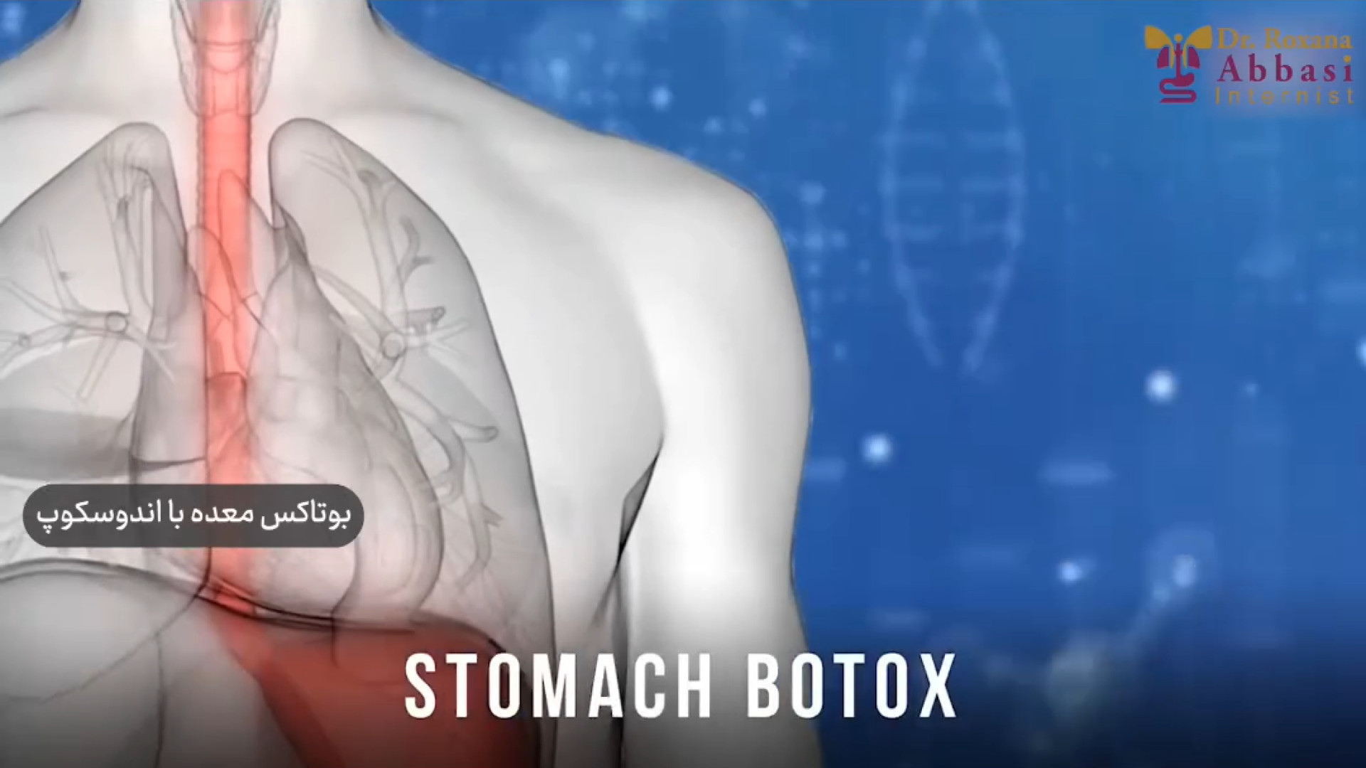 بوتاکس معده با اندوسکوپ دکتر رکسانا عباسی