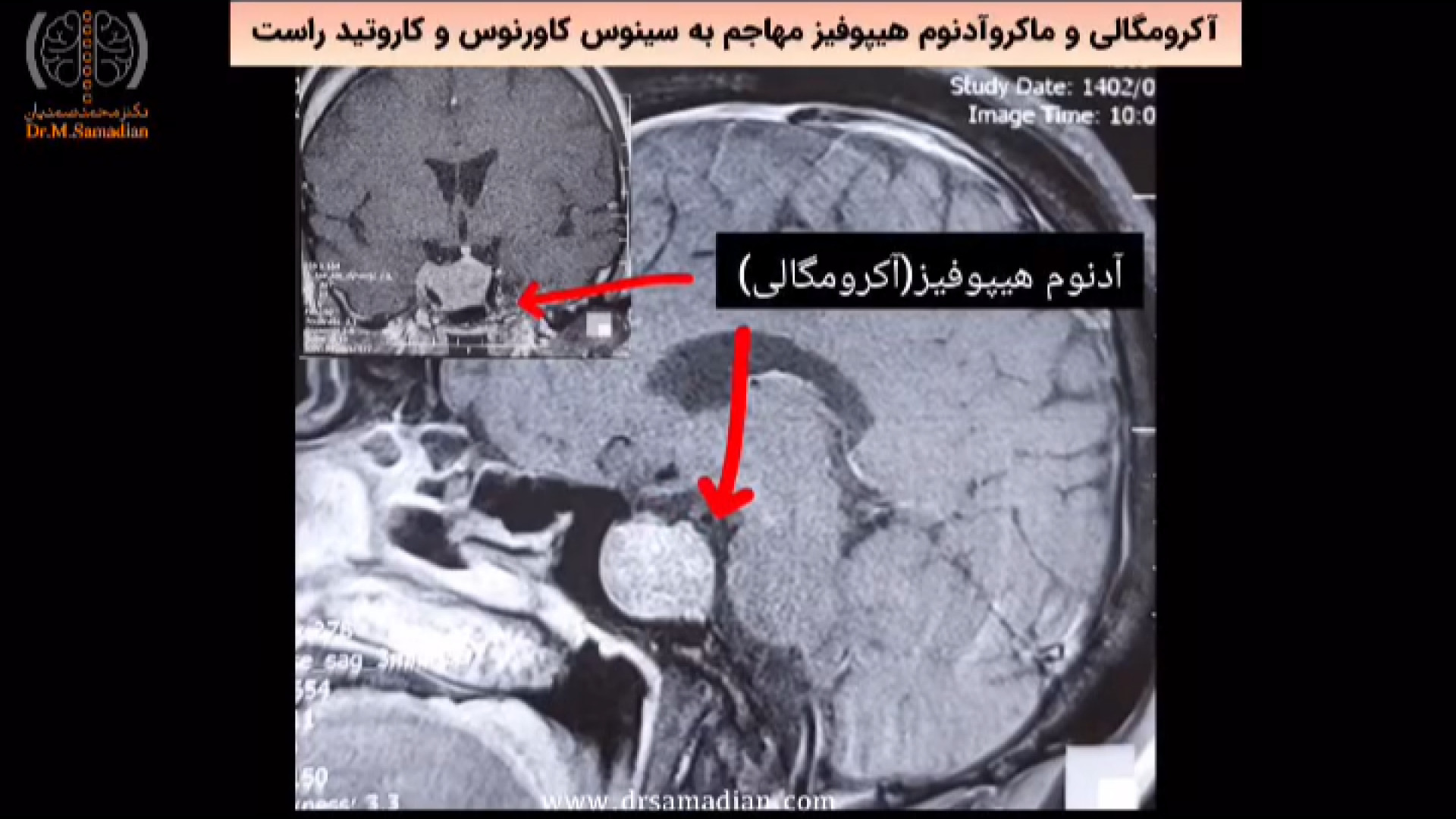 عمل آکرومگالی و ماکروآدنوم هیپوفیز مهاجم به سینوس کاورنوس و کاروتید آر اف فرکشنال