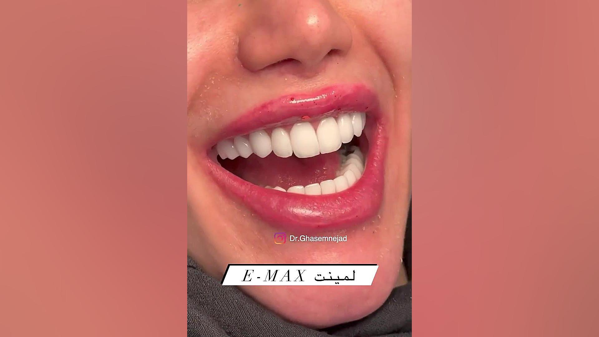 لمینت دندان جوانسازی پوست