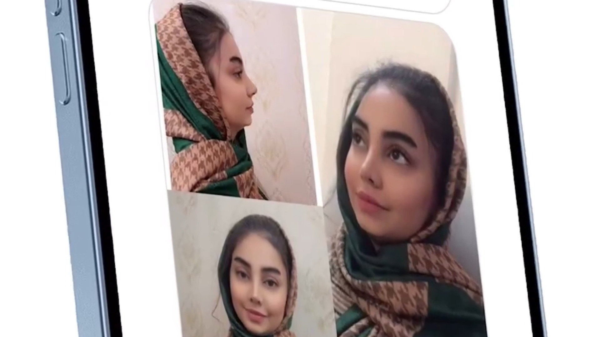 یکسال بعداز جراحی بینی دکتر فاطمه مختاری فر جراح بینی در لرستان