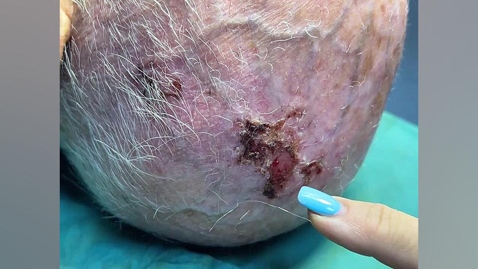 سرطانهای پوست که علت اصلی آن تابش مزمن نور آفتاب روی پوست سر و صورت دکتر فرحناز زینعلی - متخصص پوست، مو، زیبایی زنجان