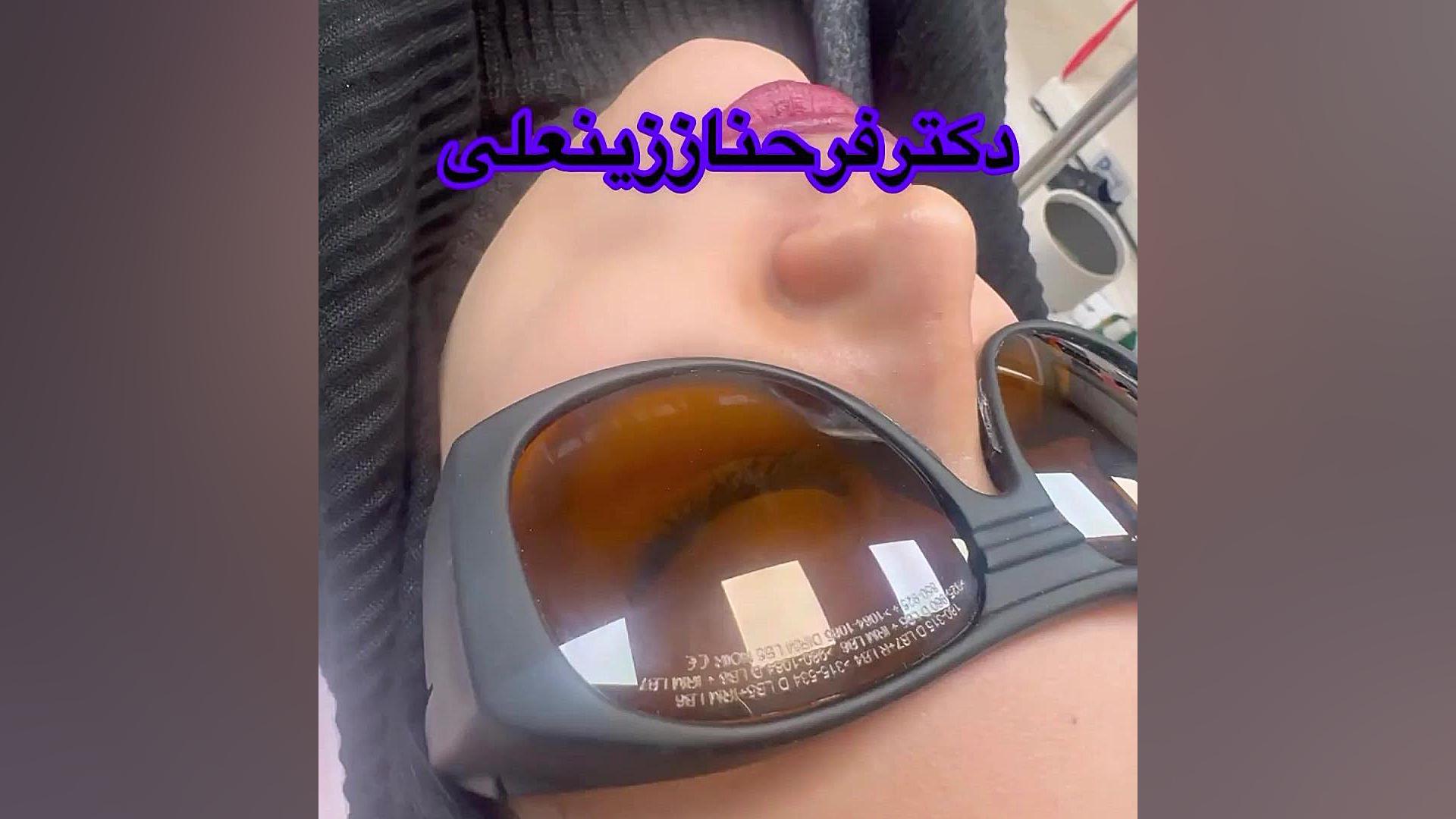 نتیجه عالی هایفوتراپی جوانسازی صورت وغبغب و آر اف ترماژ بینی دکتر فرحناز زینعلی - متخصص پوست، مو، زیبایی زنجان