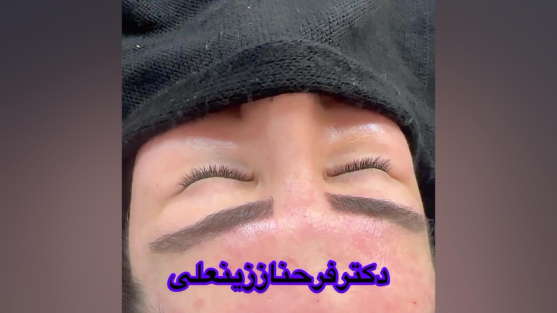 نتیجه عالی جراحی پف پلک بالا (بلفاروپلاستی) و لیزر جای جوش و آکنه دکتر فرحناز زینعلی - متخصص پوست، مو، زیبایی زنجان