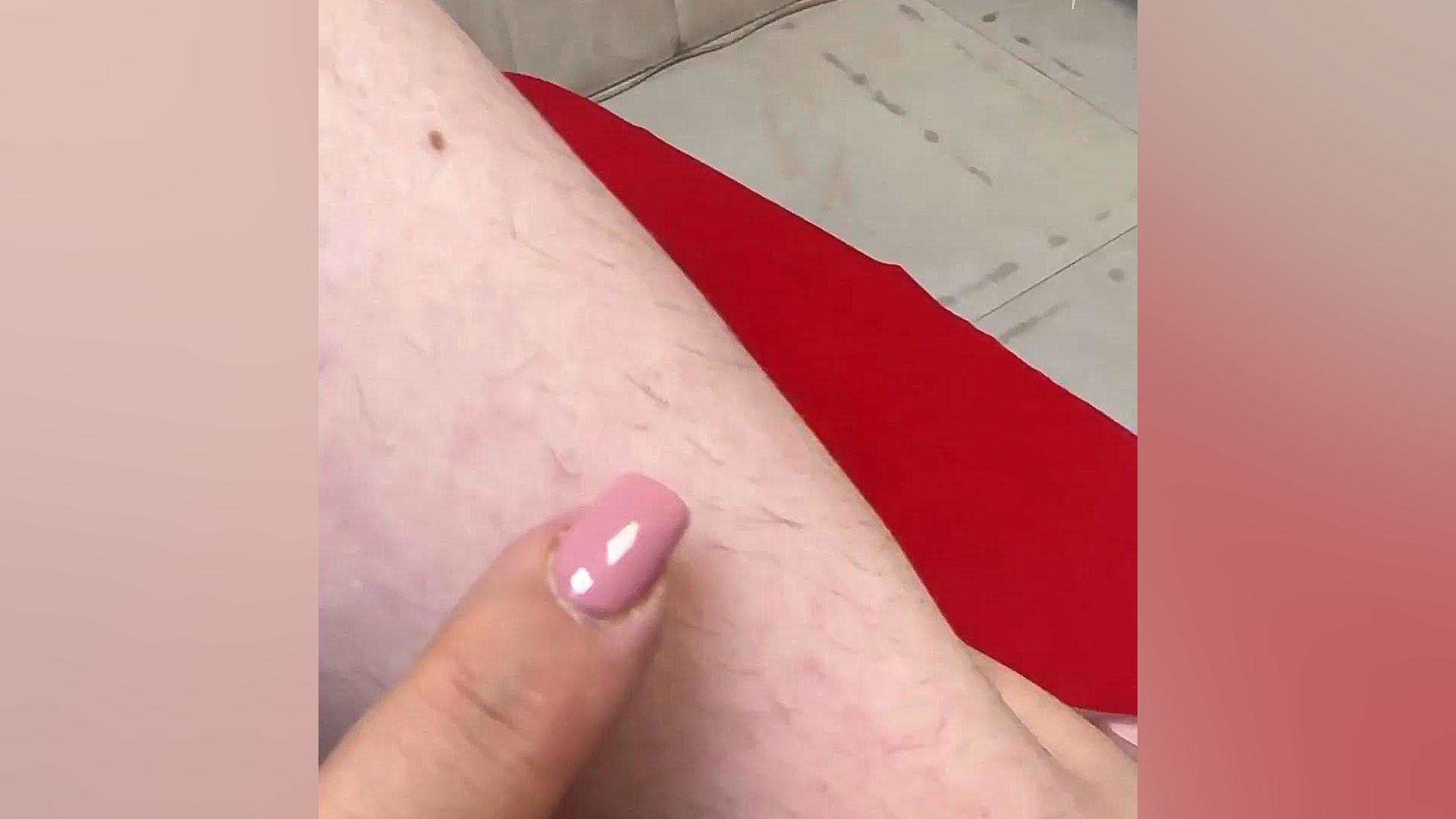 لیزر در مراکز غیر مجاز باعث هیپرتریکوز جبرانی و اضافه و ضخیم شدن موهای زائد دکتر فرحناز زینعلی - متخصص پوست، مو، زیبایی زنجان