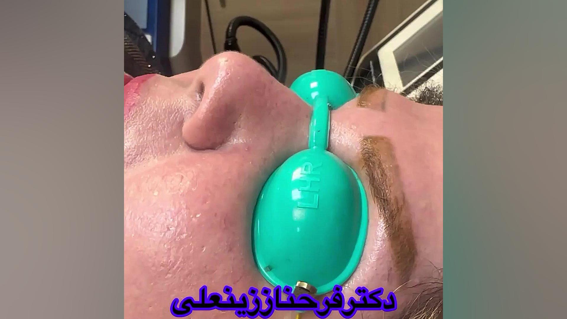 کوچک کردن بینی با پوست چرب و گوشتی با ترماژ دکتر فرحناز زینعلی - متخصص پوست، مو، زیبایی زنجان