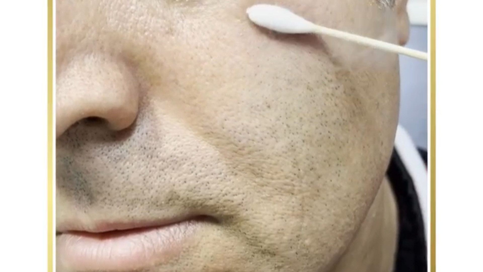 کرایوتراپی ضایعات آفتابی دکتر صدیقه نائیجی | متخصص پوست و مو در قم
