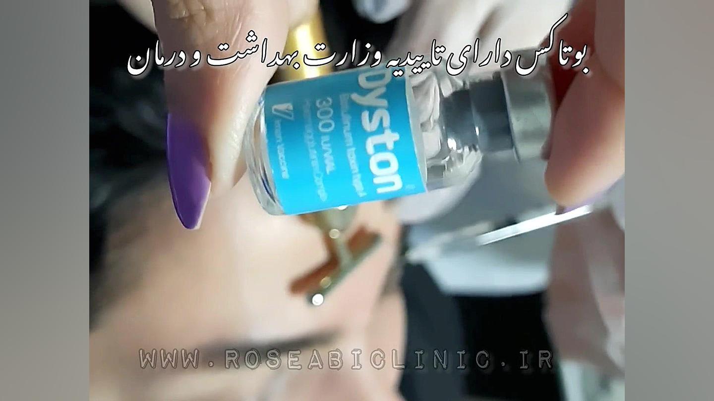 بوتاکس پیشانی کاملا طبیعی پرتاب نعل