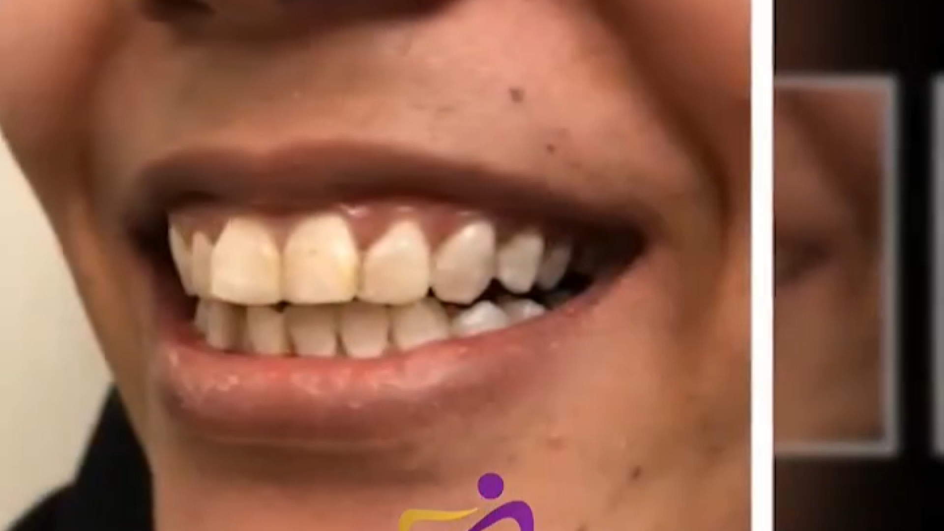 نمونه کار دکتر ندا هادی دکتر ندا هادی-دندانپزشک زیبایی