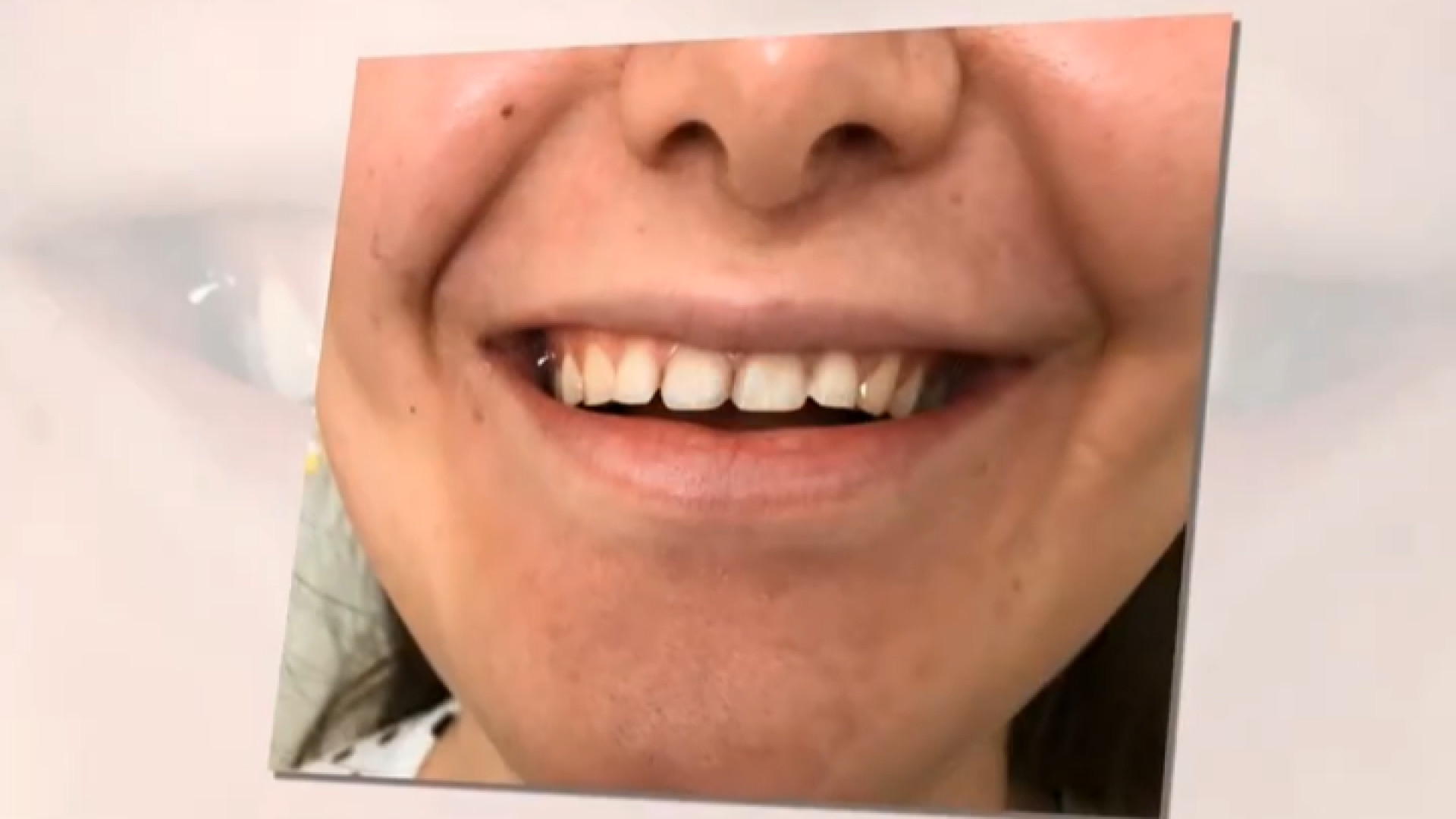 اضلاح طرح لبخند با دکتر هادی دکتر ندا هادی-دندانپزشک زیبایی