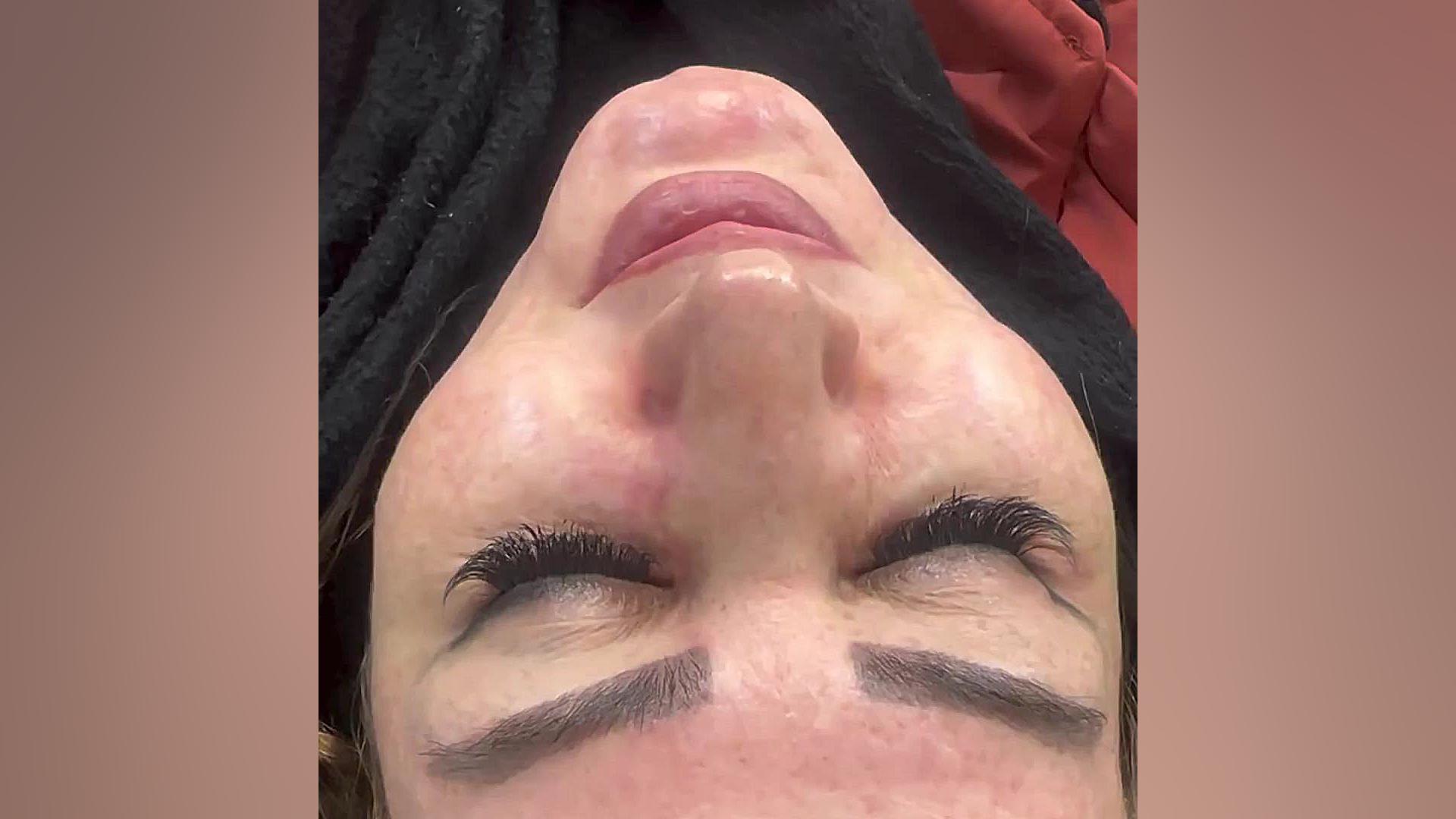 نتیجه عالی و رضایت کامل مراجع عزیزمان از تزریق چربی به صورت و لیزر لک آر اف فرکشنال