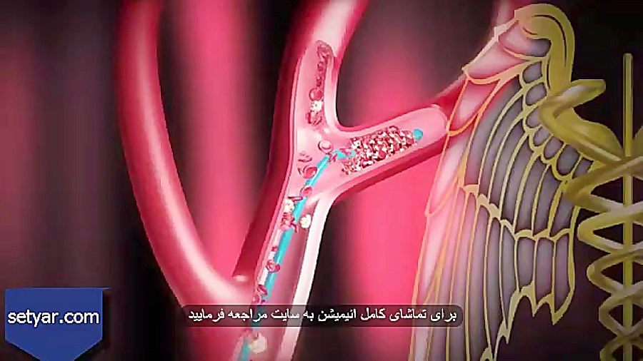 انیمیشن سکته مغزی و درمان آن دندانپزشکی کودکان