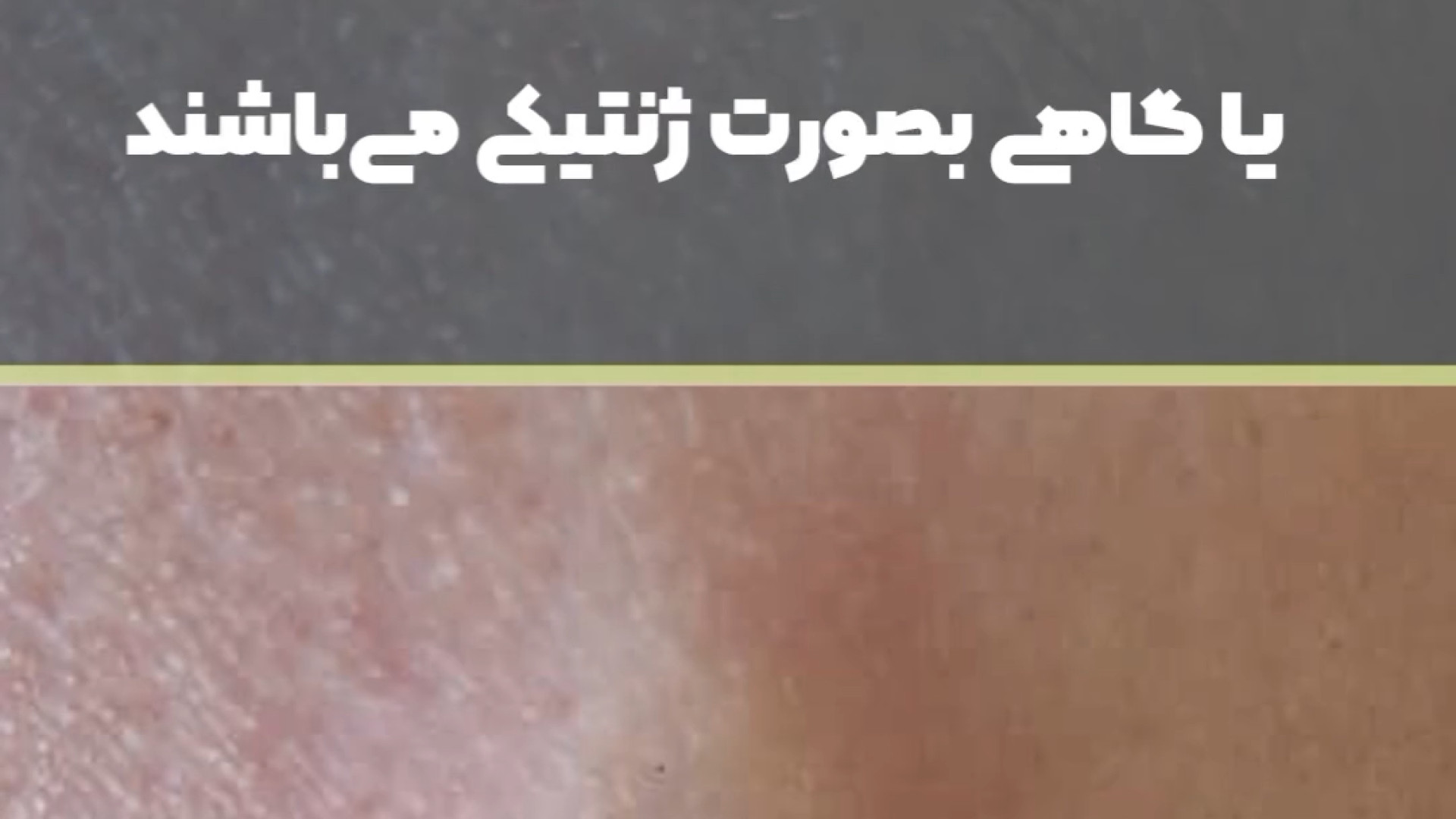 فیلم عمل کیست صورت دکتر ایمان روغنی جراح و متخصص پوست و مو