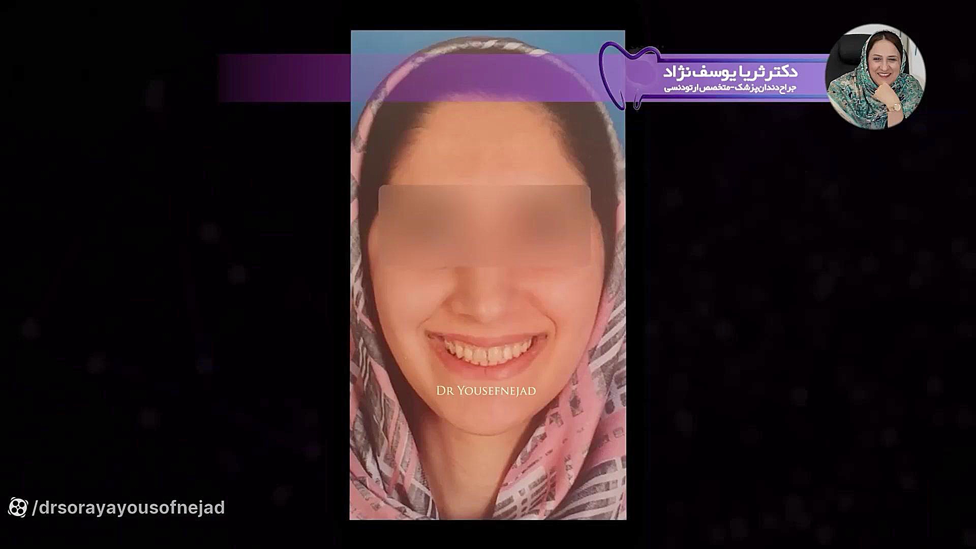 درمان دندان نیش نهفته توسط ارتودنسی دکتر ثریا یوسف نژاد متخصص ارتودنسی بابل