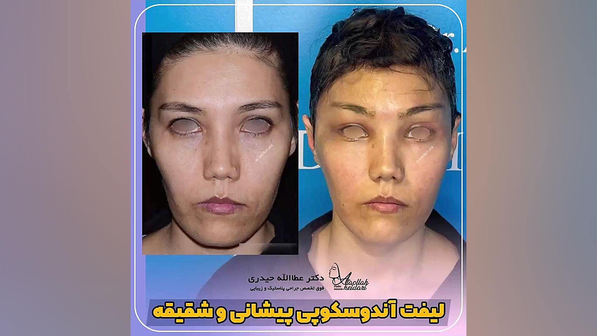 لیفت آندوسکوپی پیشانی و شقیقه | دکتر عطا حیدری مگالودکس