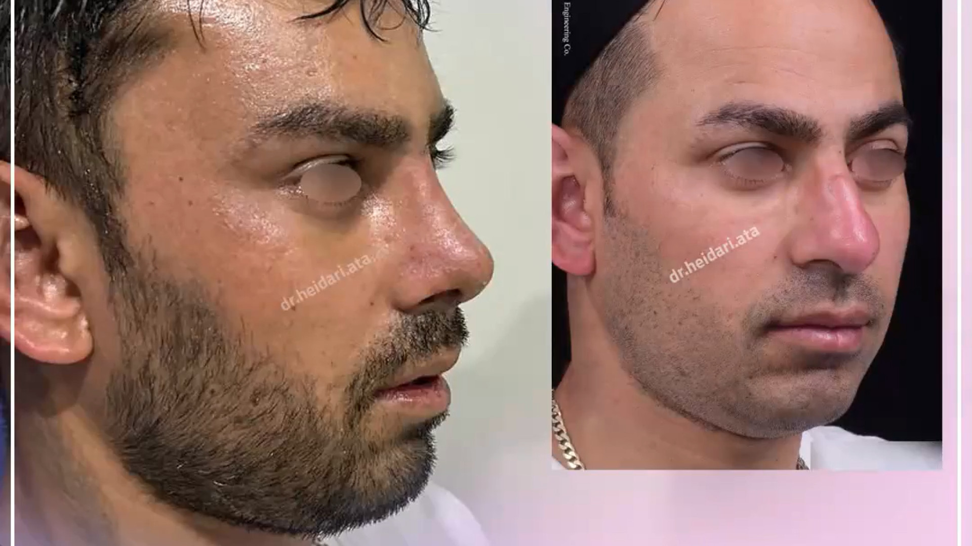 لیفت آندوسکوپی پیشانی و جراحی بینی و رفع اسکار بینی هایپررفلکسی