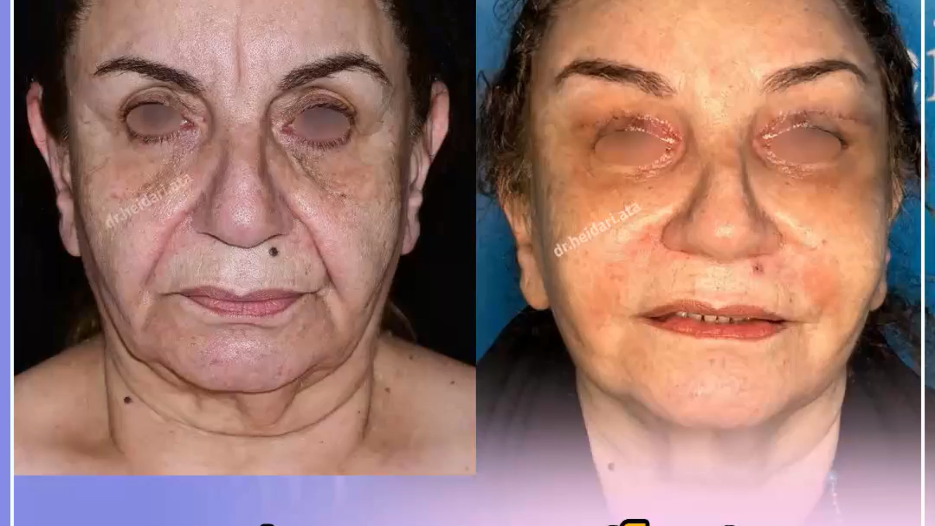 لیفت آندوسکوپی پیشانی ، بلفاروپلاستی و تزریق چربی | دکتر عطا حیدری ترمیم لبخند لثه‌ای