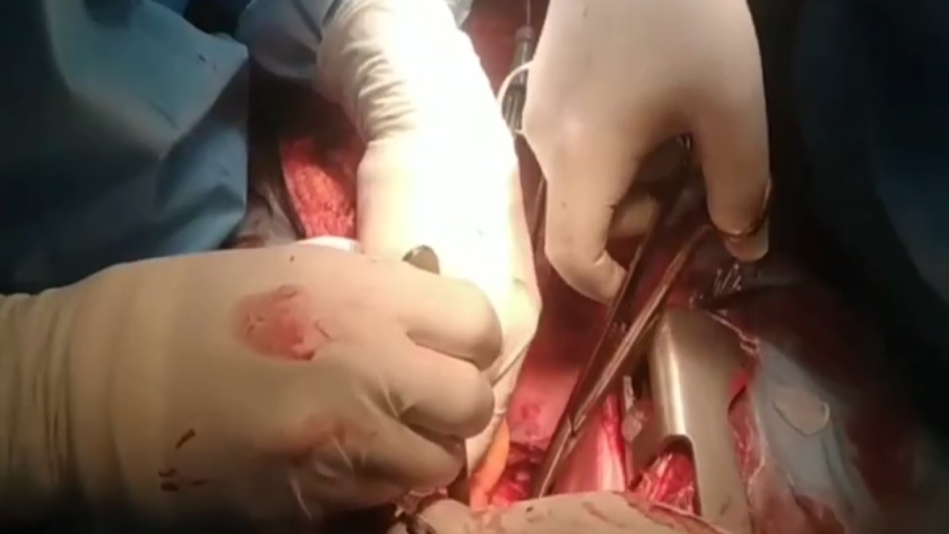 صدمین عمل موفق پیوند قلب دکتر رضا باقری جراح سینه در مشهد