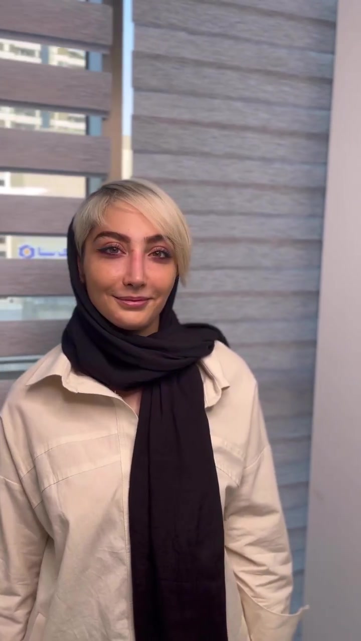 نتیجه رینوپلاستی طبیعی شیک پس از یک ماه دکتر محمد مجیدی - جراحی بینی به سبک طبیعی شیک