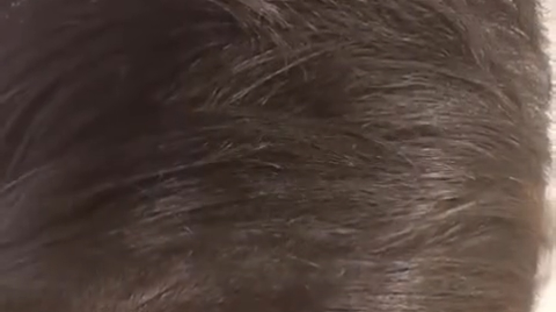 نتیجه روش ترکیبی تقویت مو دکتر آریا شفیعی